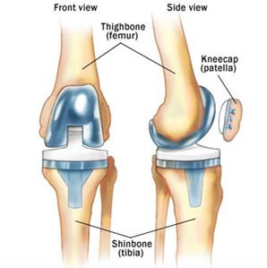knee-replacement-surgery3