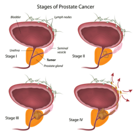 cost-of-prostate-cancer-treatment-in-india