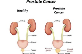 Prostate-Cancer456